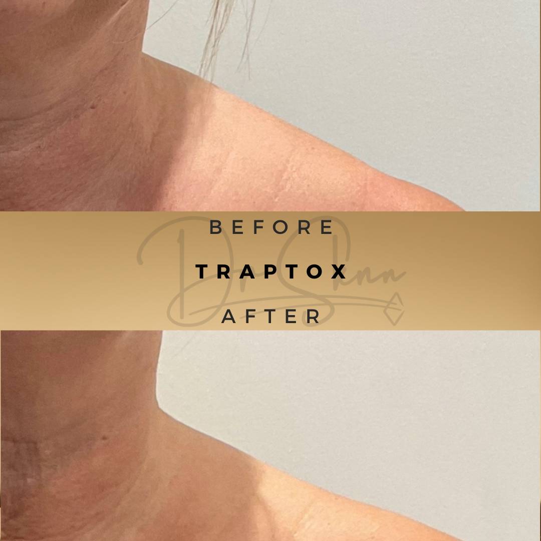 TrapTox Wilmslow Before & After Dr Sknn