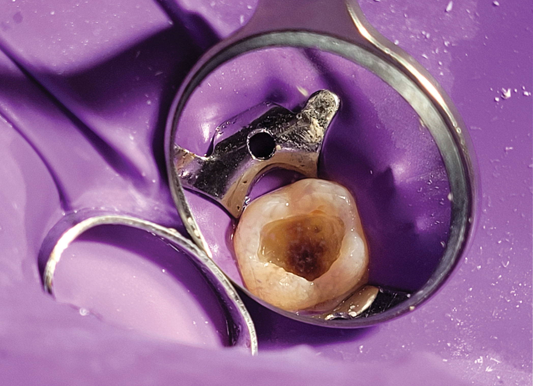 isolated tooth with purple dental dam undergoing endodontic procedure