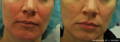 Woman's red cheeks before and after Lumecca IPL
