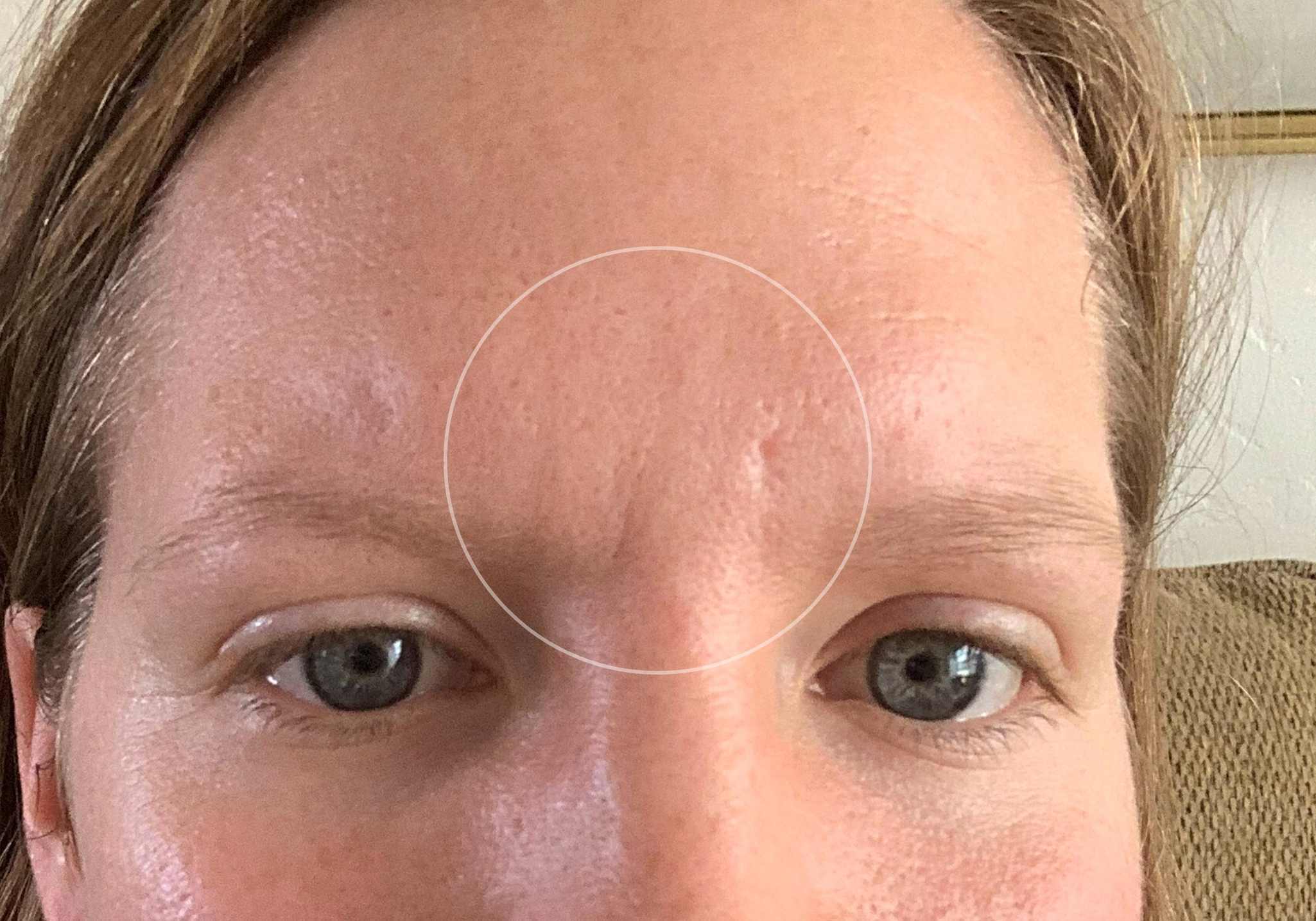 collagen-before-and-after-pictures-wrinkles-forehead-between-eyebrows