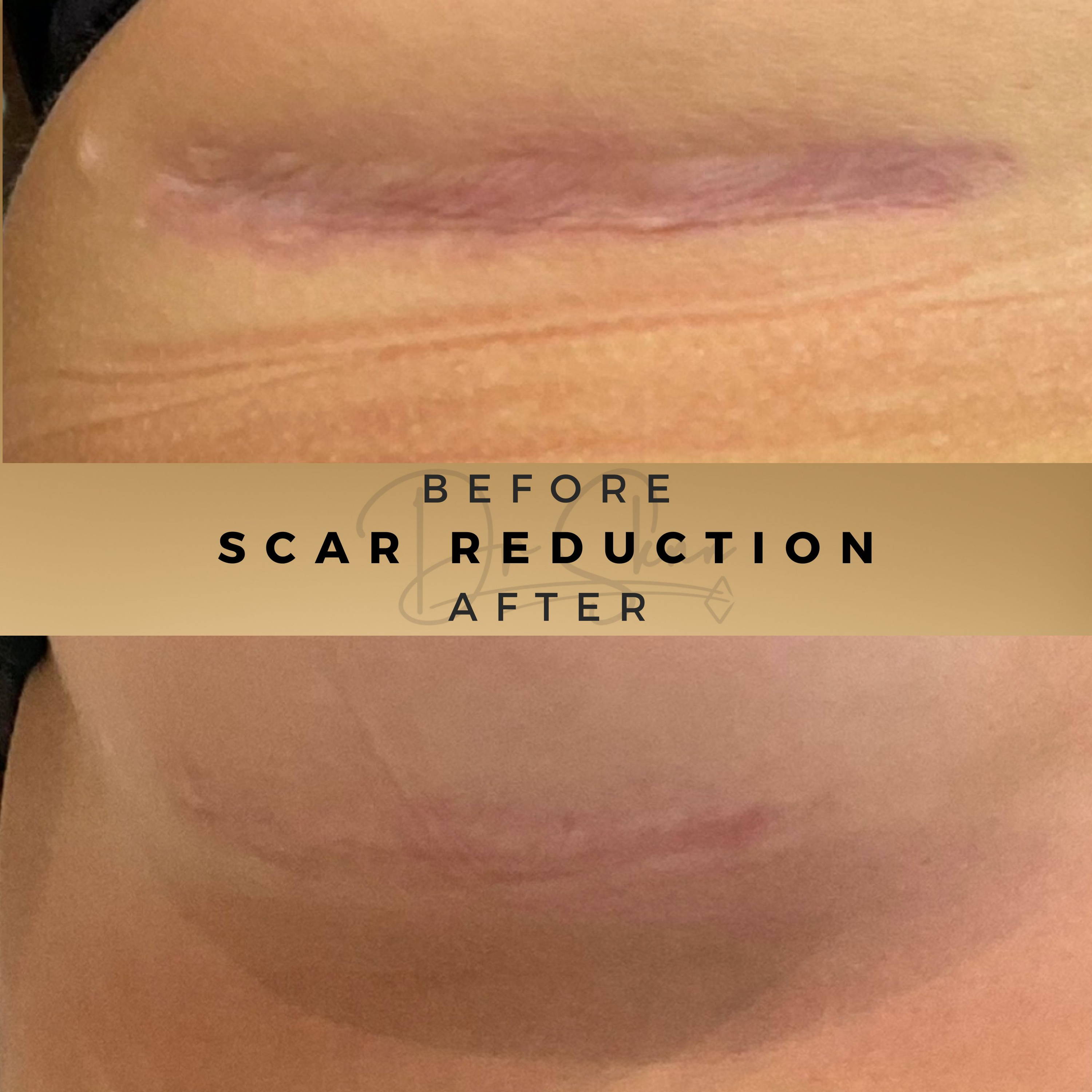 Scar Reduction Wilmslow - Breast Scar Reduction