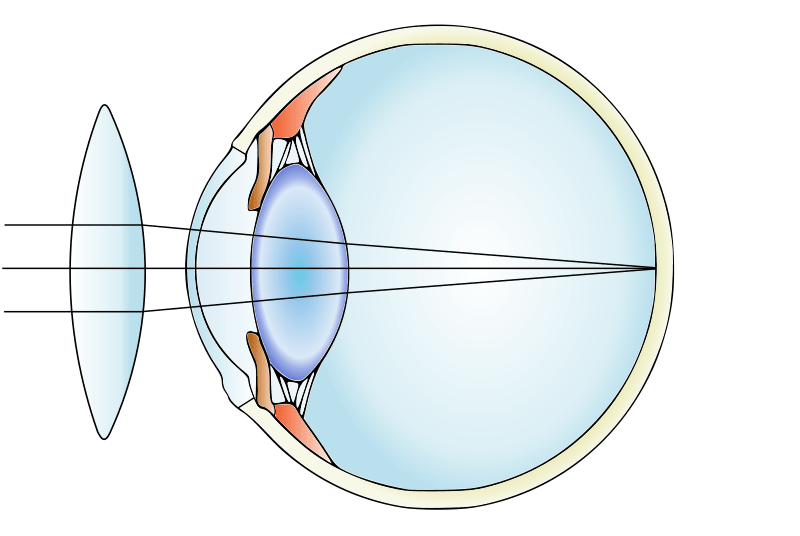 Correction of a farsighted or hyperopic eye