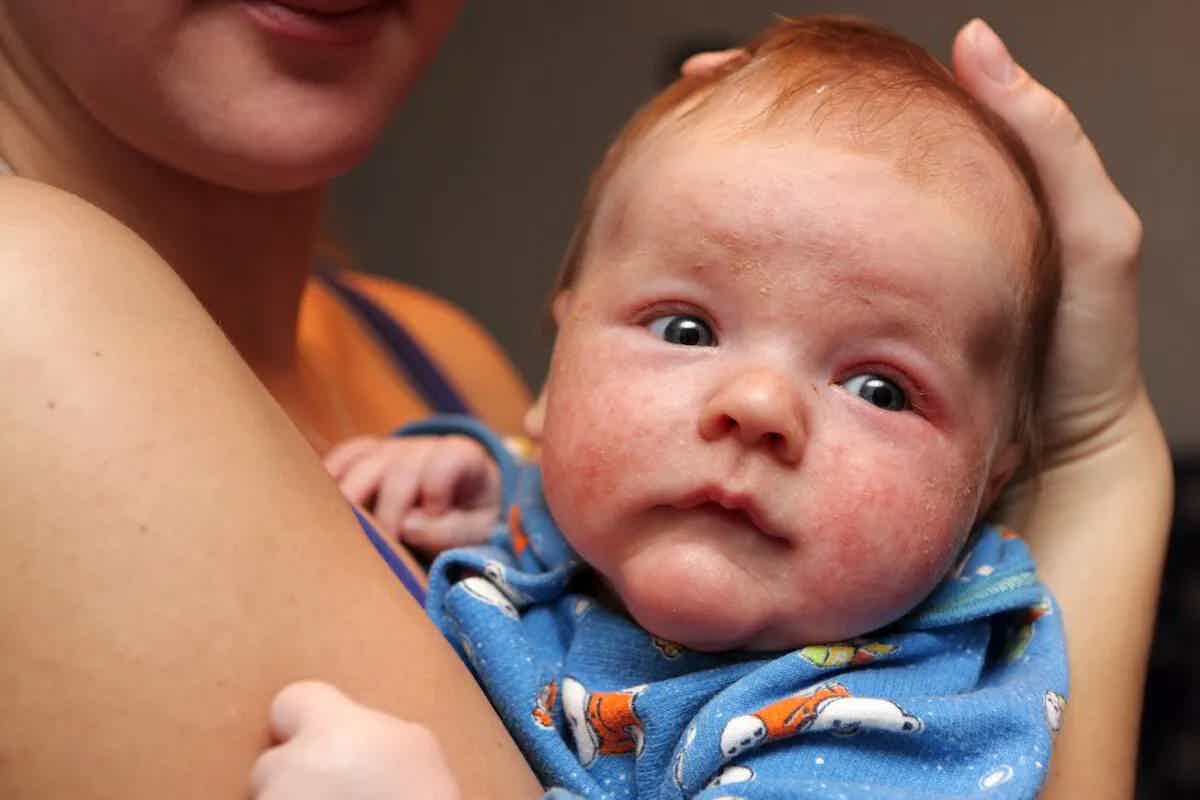 How To Improve Eczema In Young Children