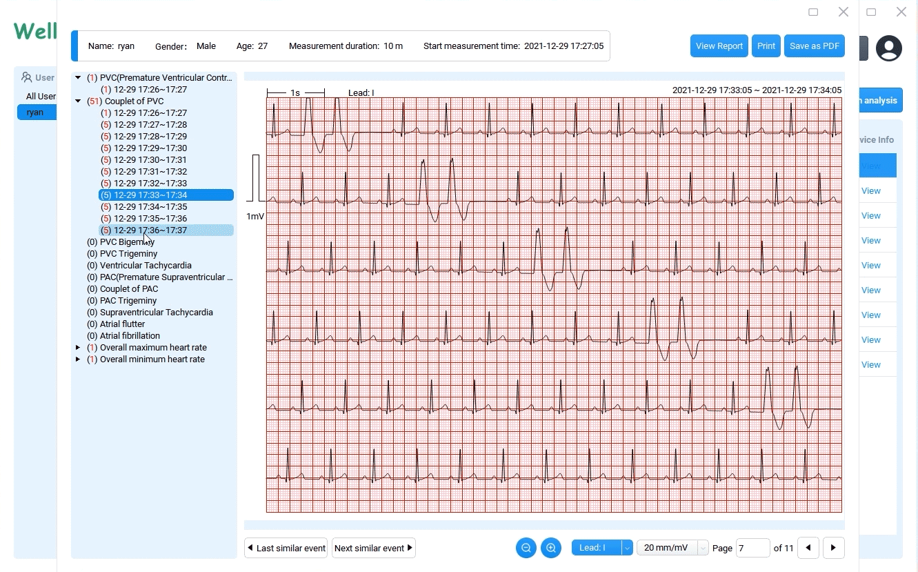 Laden Sie EKG-Kurven mit 12 Ableitungen herunter