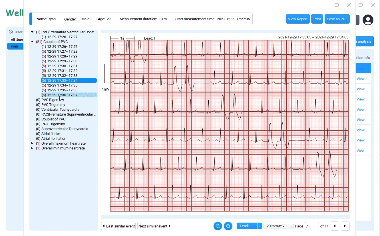 download 12 leads ECG waveforms 