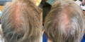 Nulastin-Scalp-Hair-Results-Before-After