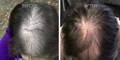 Nulastin-Scalp-Hair-Results-Before-After