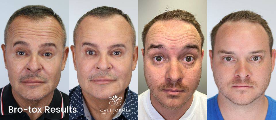 botox, juvederm before and after images