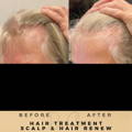 Hair Loss Treatment Dr Sknn Before & After Picture