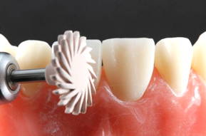 Peach polisher touching anterior tooth