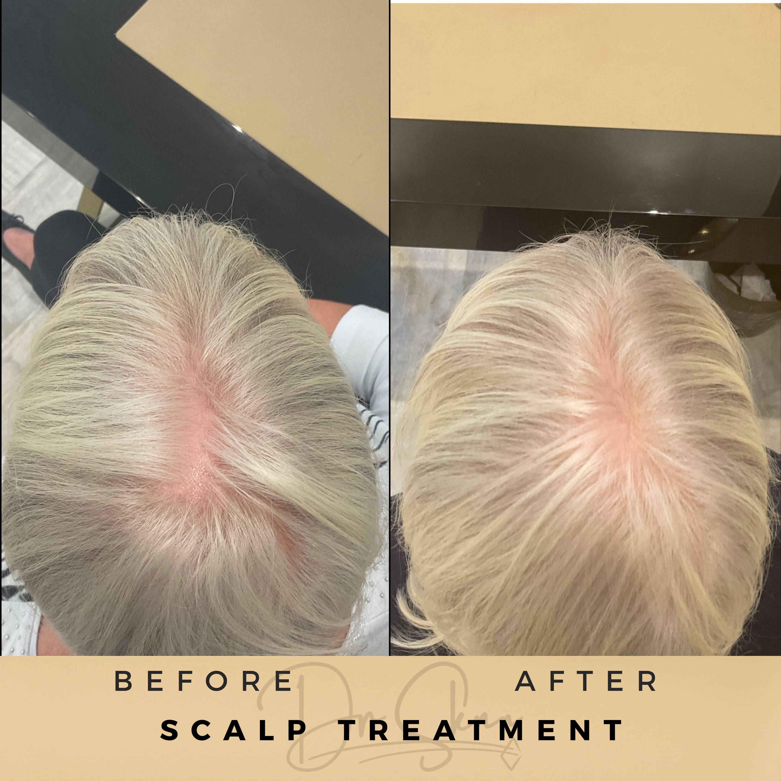 Scalp Treatment Wilmslow Before & After Dr Sknn