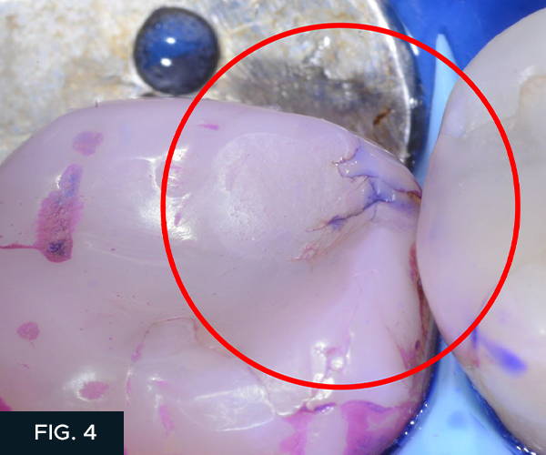 The disclosing solution has been applied, rinsed, and then dried.  Notice that not only you are seeing the biofilm on the tooth, but the structural crack in the composite has become apparent.