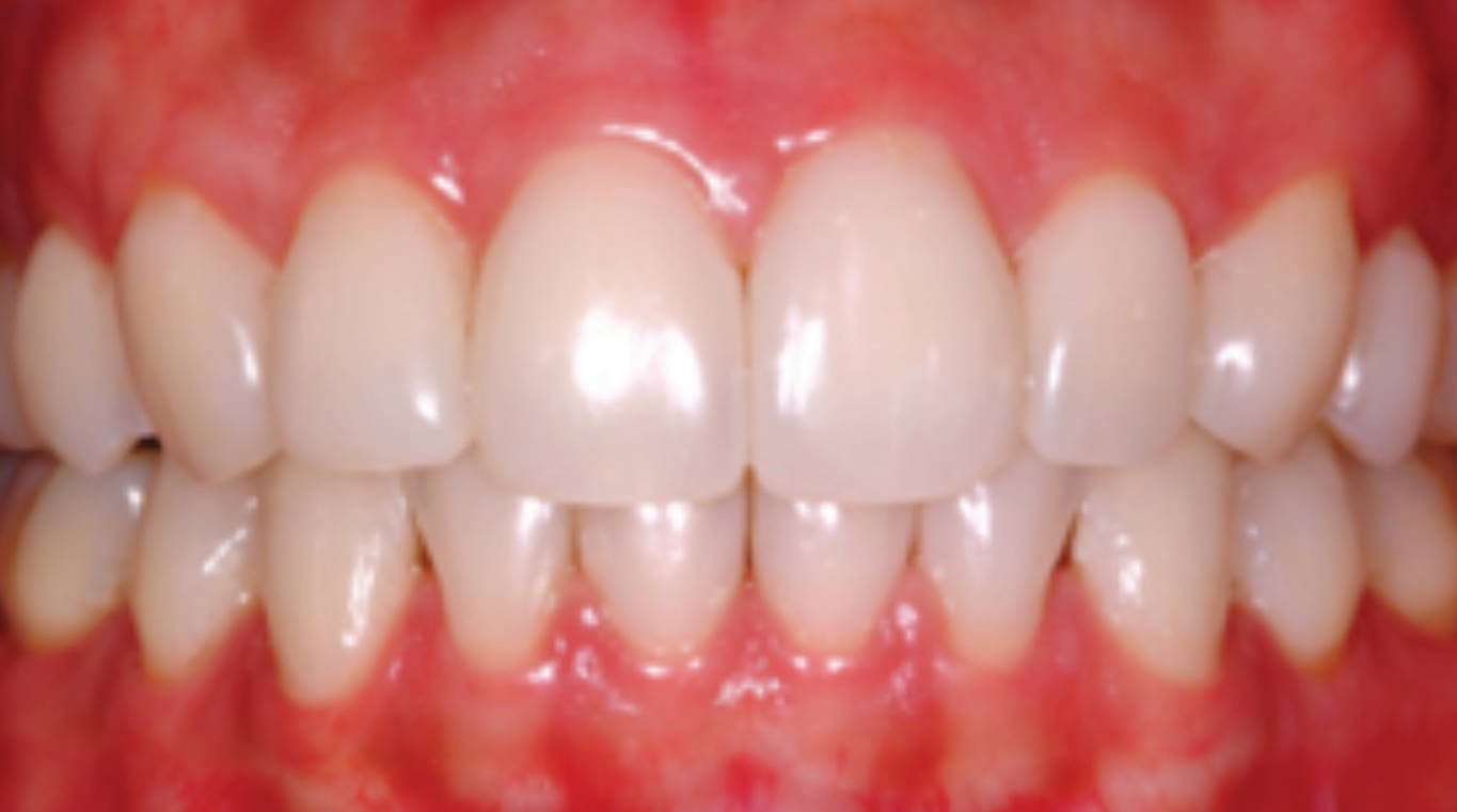 a post-op image featuring closed black triangles using the warmed composite injection molding