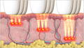 Thermal Diffusion Treatment