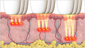 Thermal Diffusion Treatment