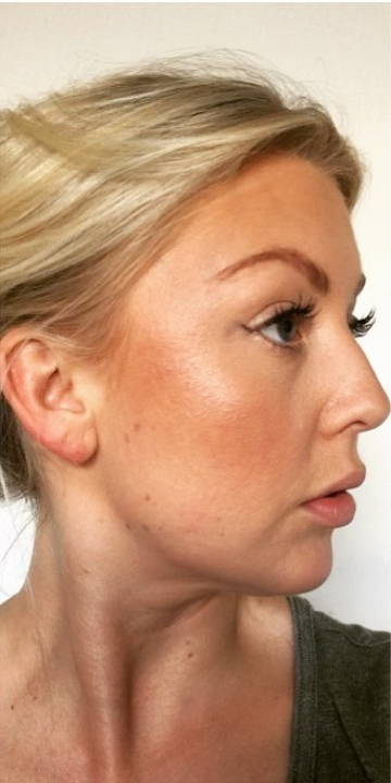 WunderHaut Anti-Aging Genius™ mit Radiofrequenz, LED Licht- und Mesotherapie, EMS und Elektroporation
