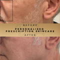 Personalised Skincare Dr Sknn Before & After Picture