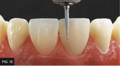 Bur placing depressions on tooth