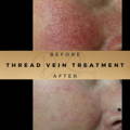 Before & After Pictures Dr Sknn Wilmslow Cheshire