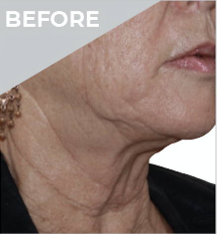 Dr Sknn Non-Surgical Face & Neck Lift Before
