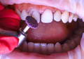 asap dailies polisher polishing tooth