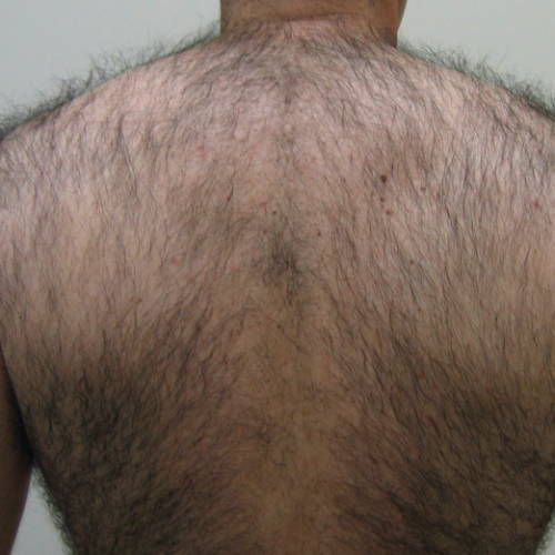 Intense Pulsed Light Hair Reduction - Before