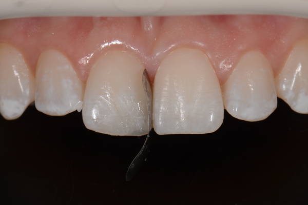 teeth with matrix band in between