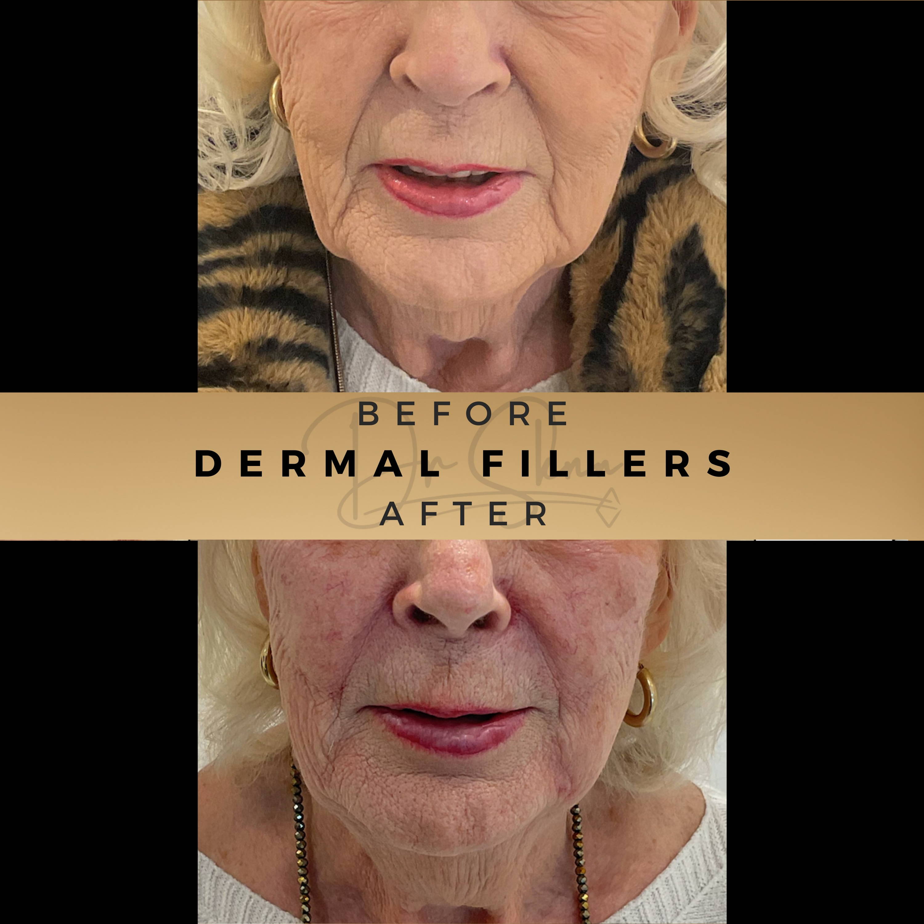 Nasolabial Fold Fillers Wilmslow Before & After Dr Sknn Wilmslow Before & After Dr Sknn