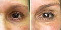 Nulastin Lash Serum Results Before After