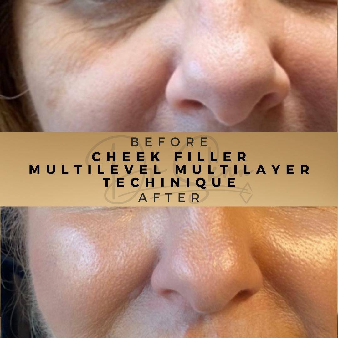 Cheek Fillers - Dr Sknn before and after