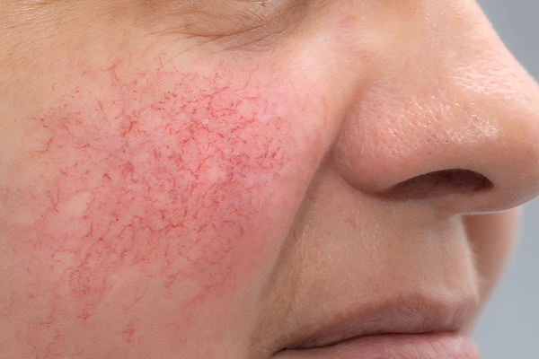 Lovely Skin and Beauty - Facial Spider Vein Package - Image 2