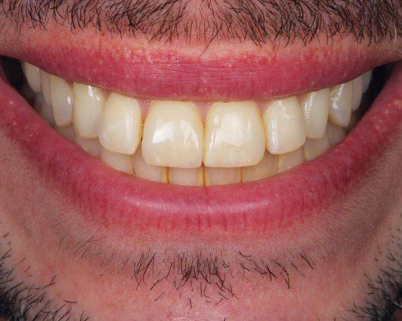 Smile with front tooth restored