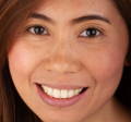 Woman smiling showcasing new smile 4 years after treatment