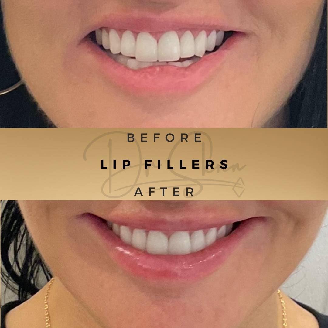 Lip Fillers - Dr Sknn before and after