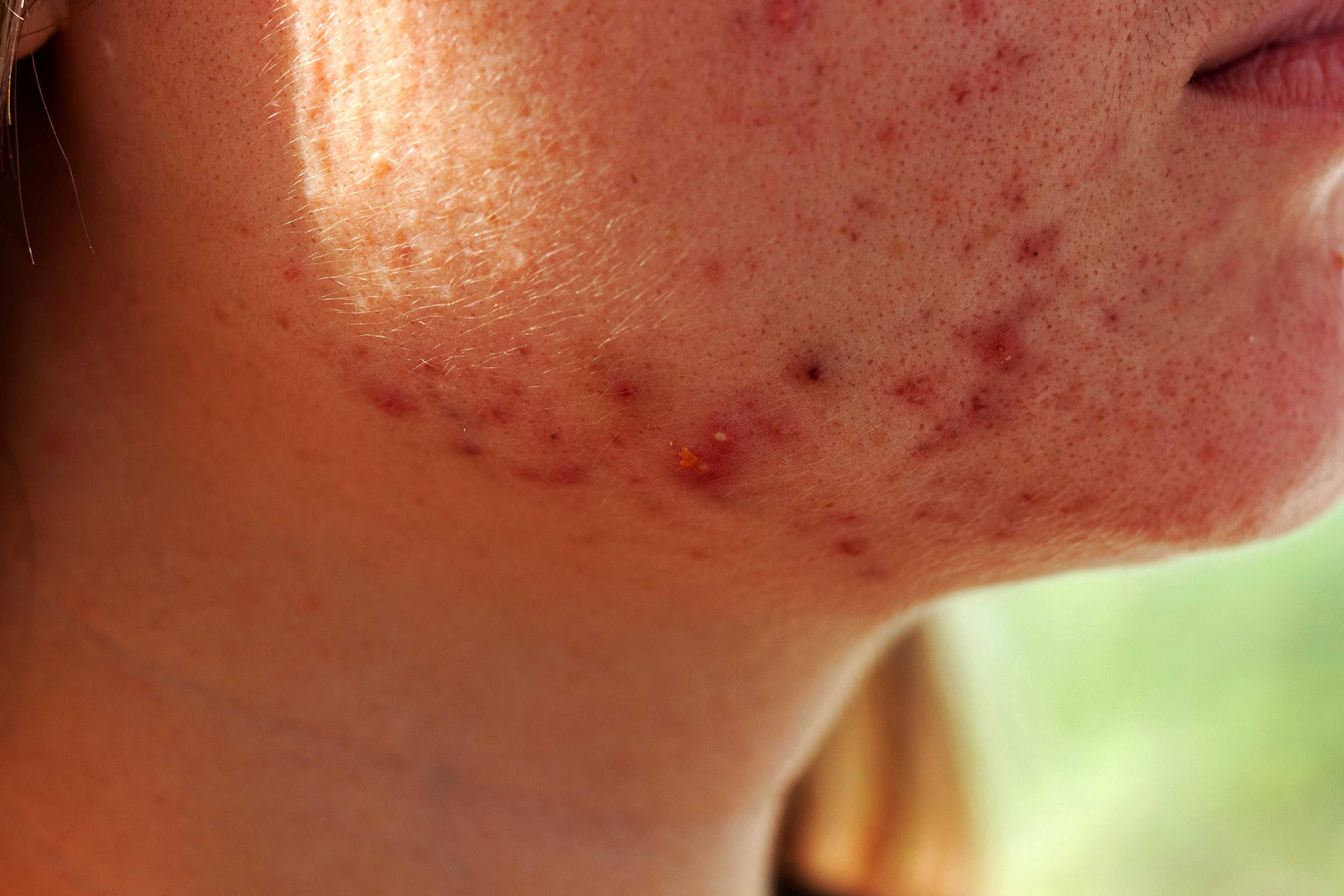 What Tanning Does To Your Acne According To Dermatologists