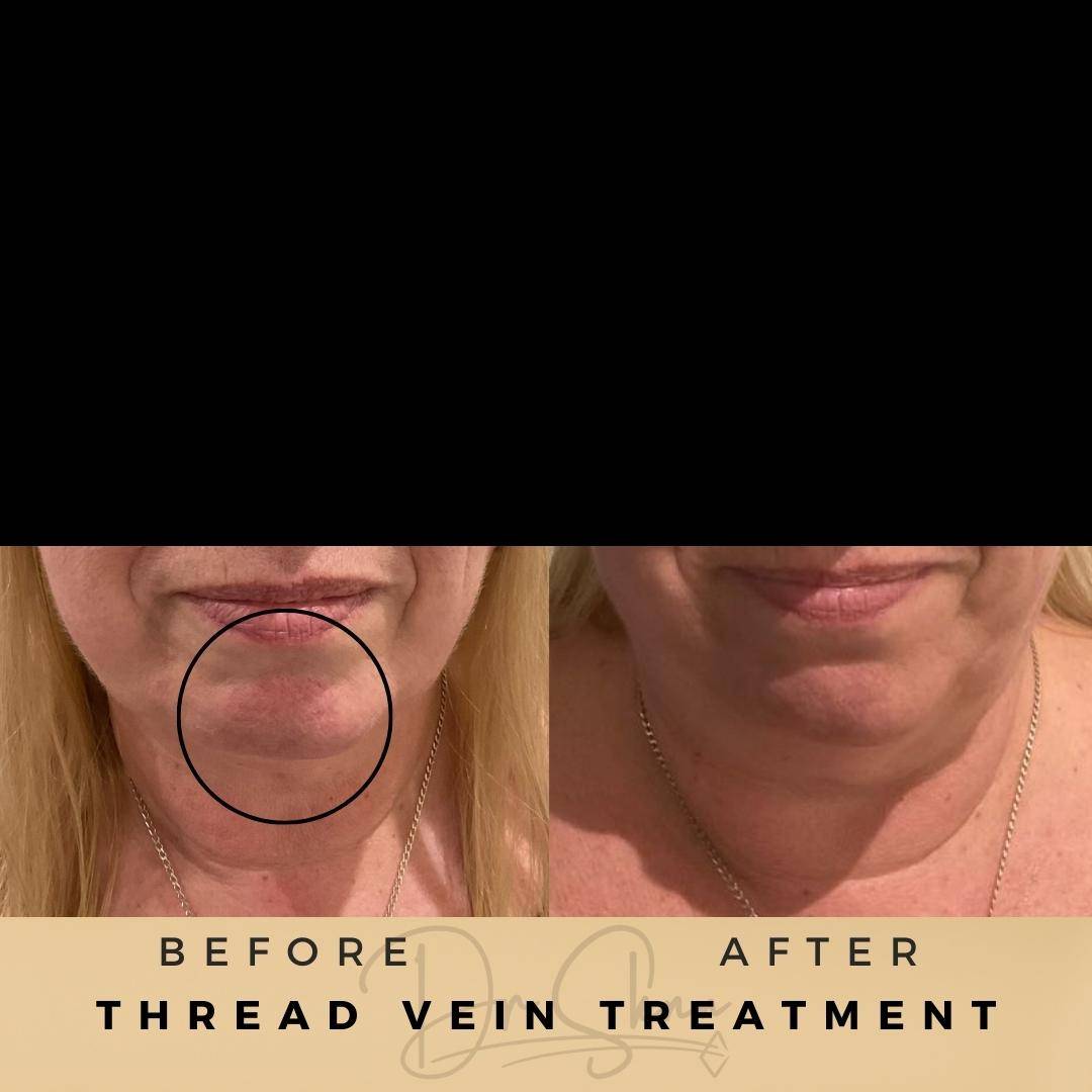 Vascular Treatment Thread Vein Treatment Wilmslow Before & After Dr Sknn
