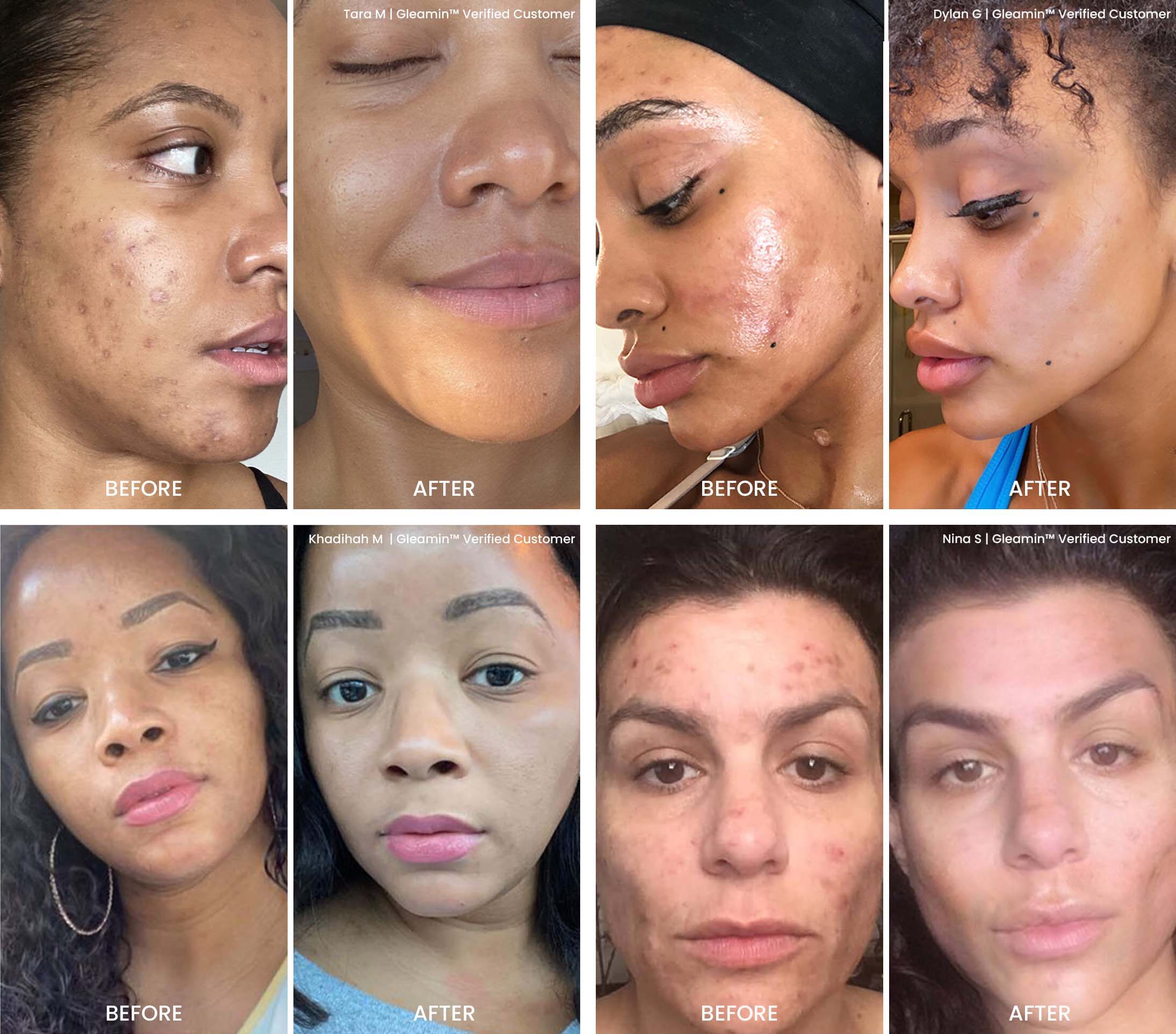 Real Before and Afters Using Gleamin Face Mask