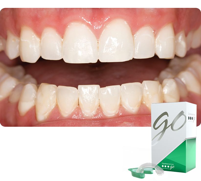 Opalescence teeth: after. The result of hydrogen peroxide in teeth whitening