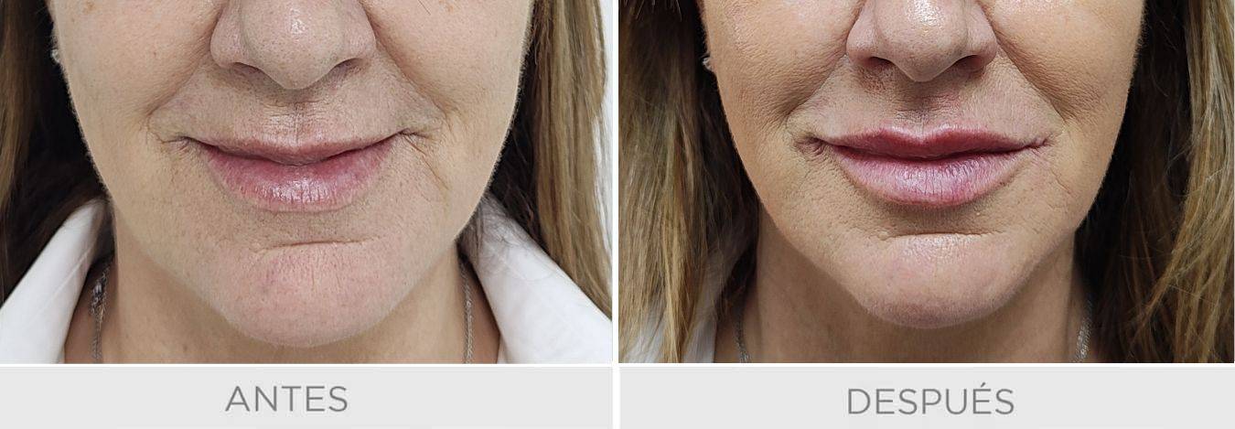 labios rellenos acido hialuronico