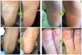 pHeet Foot Wipes before and afters showing great results.