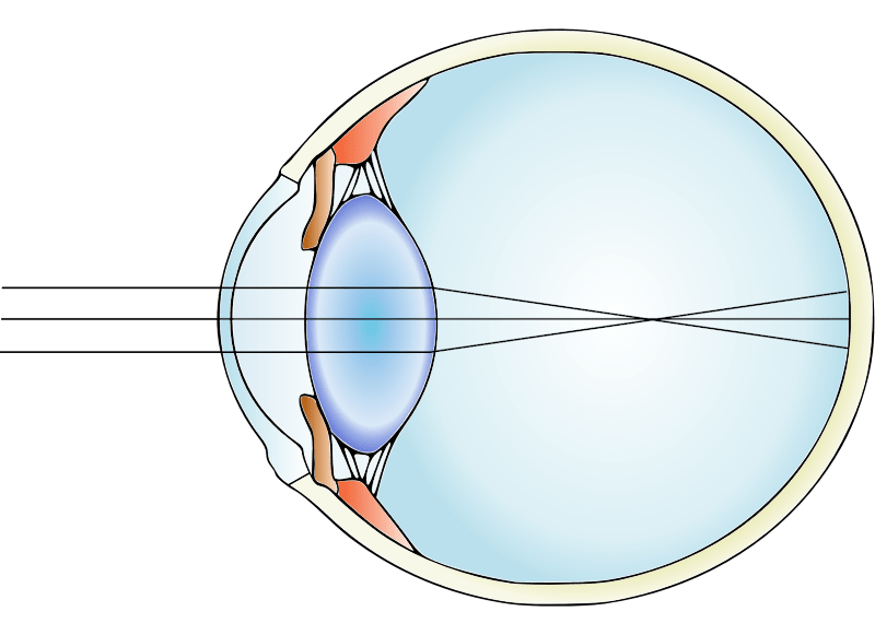 Nearsighted or myopic eye