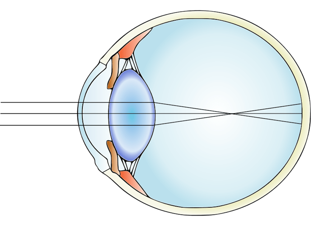 Light not focusing properly in nearsighted eye