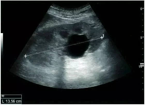 Normal adult kidney ultrasound, longitudinal view — EagleView portable ultrasound.
