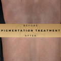 Before & After Pictures Dr Sknn Wilmslow Cheshire