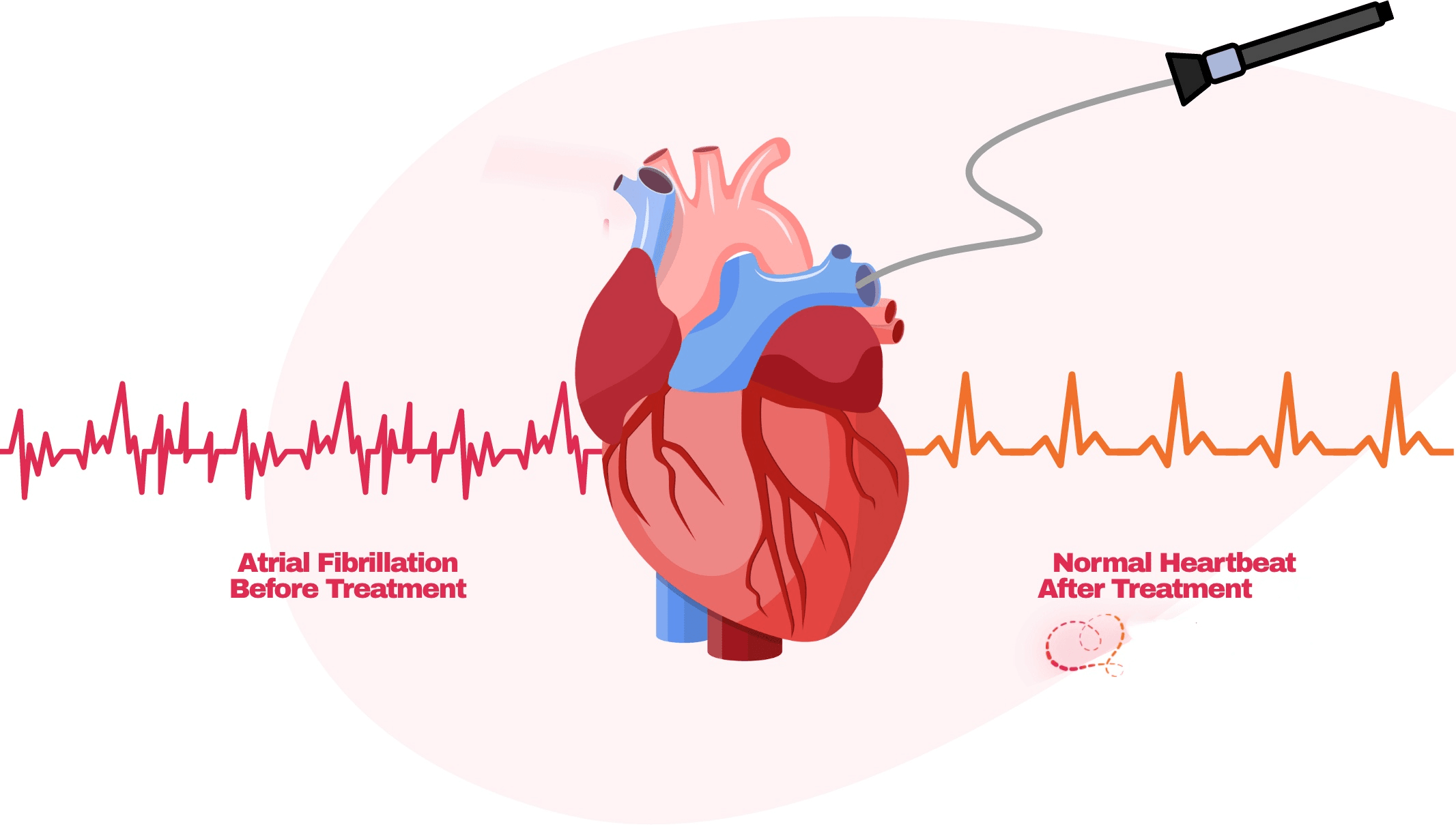 traitement pour AFib