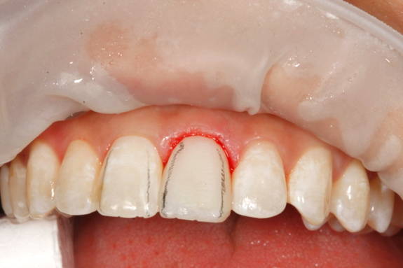 Anterior tooth restored with grey marks in it