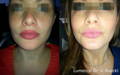 Woman's face before and after Lumecca IPL for pigment