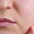 closeup of face with irritation caused by retinol