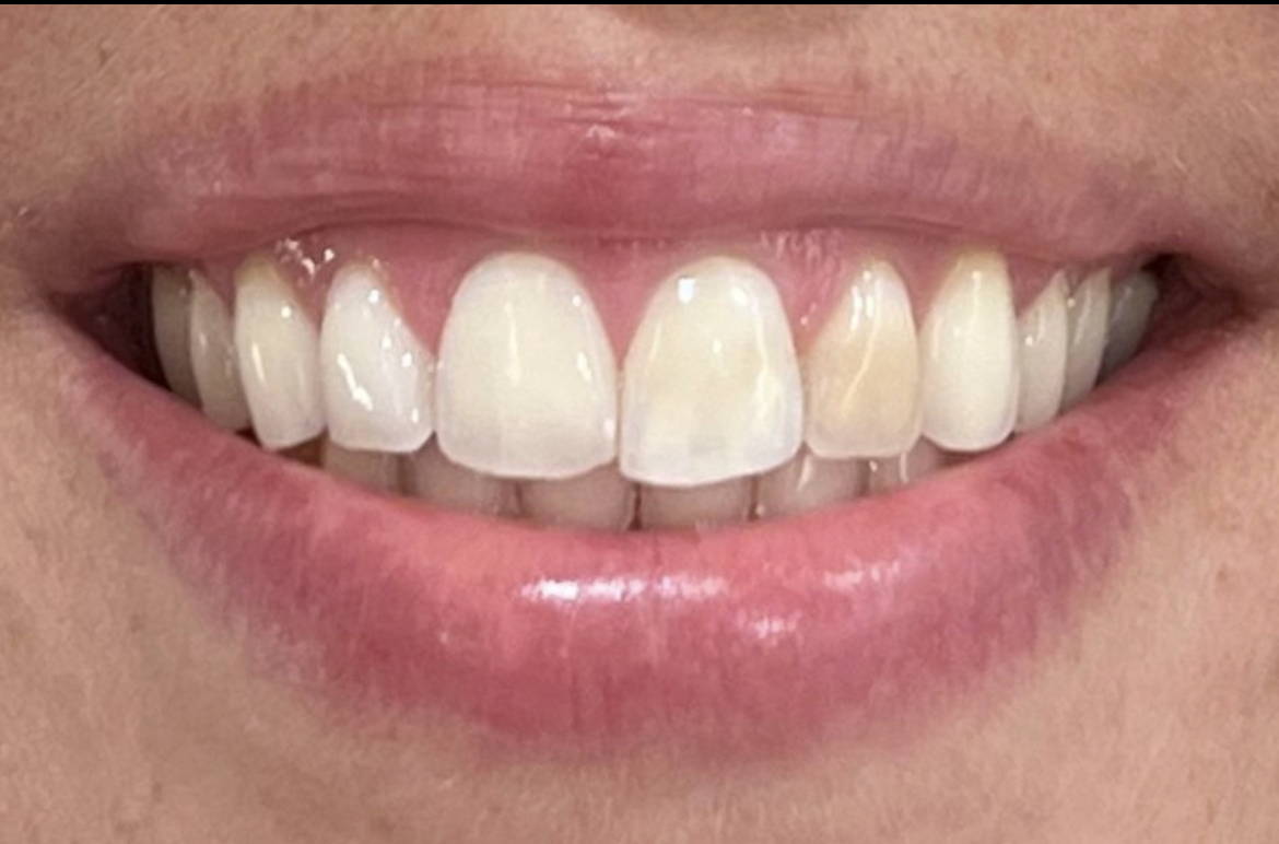 Smile with discoloured tooth on the right side