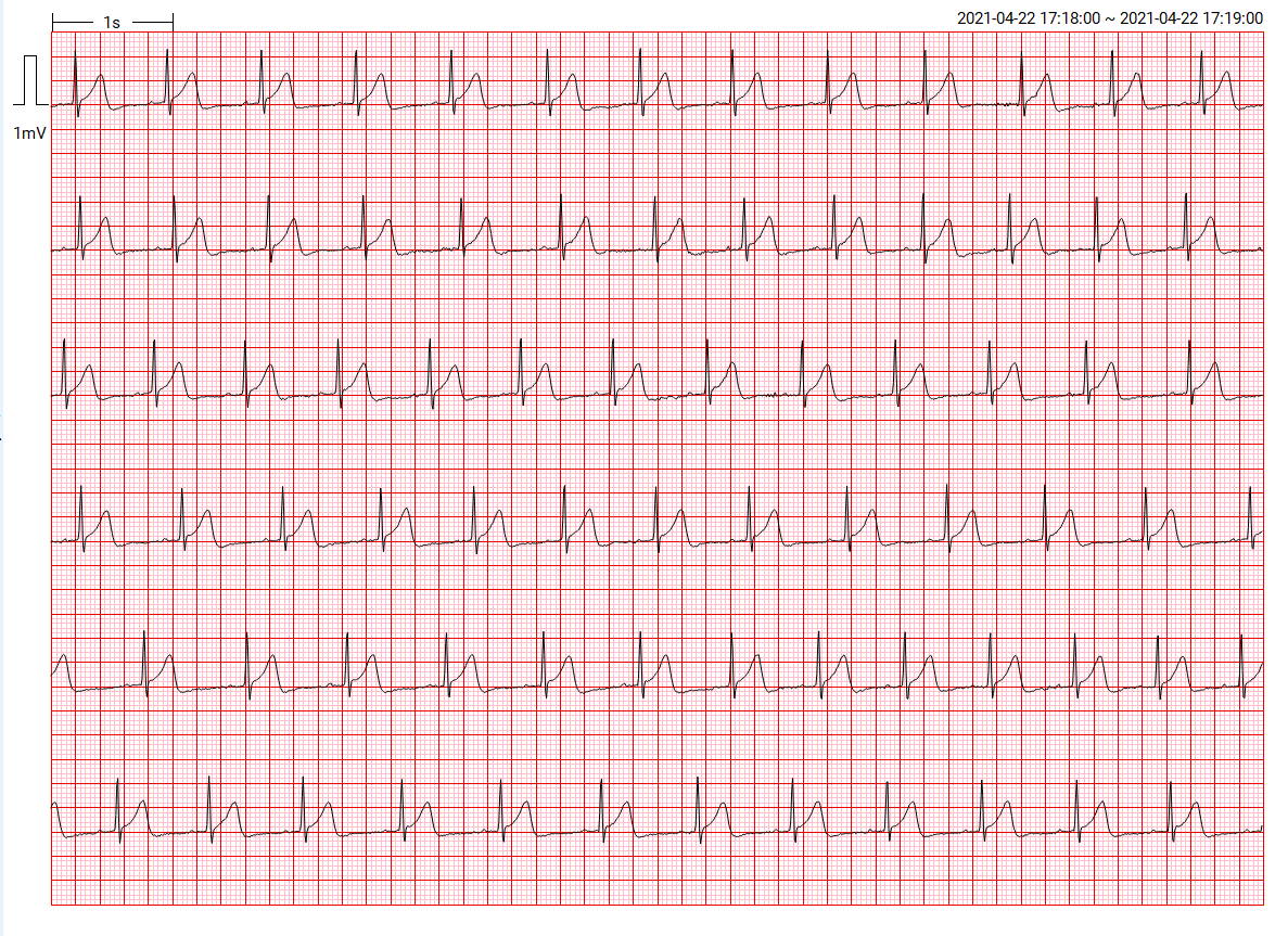ECG monitor, EKG monitor, ECG test, ECG report, ECG analysis, ECG Holter, Artificial Intelligence-Enabled ECG Algorithm, Artificial intelligence-enhanced electrocardiography